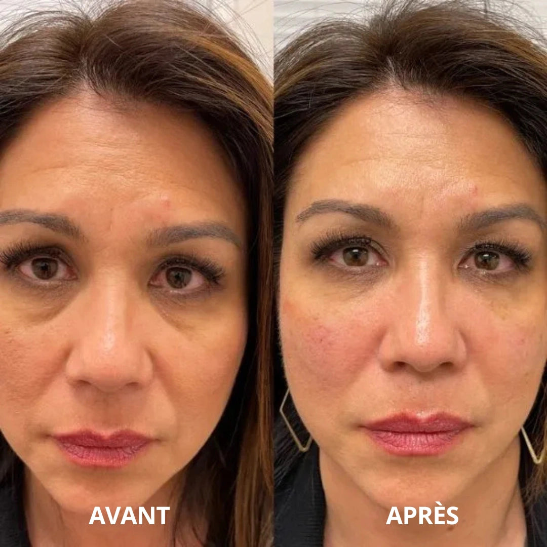 PATCHS ANTI-CERNES HYDROGEL